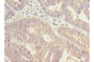 Immunohistochemistry of paraffin-embedded human endometrial cancer using ABIN7143769 at dilution of 1:100 (ALG2 Antikörper  (AA 197-416))