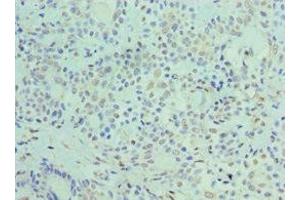 Immunohistochemistry of paraffin-embedded human breast cancer using ABIN7162890 at dilution of 1:100 (ADRP Antikörper  (AA 168-437))