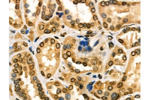 ABIN6257144 and ABIN6274130 at 1/100 staining Human kidney cancer and adjacent normal tissues by IHC-P.