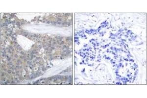Immunohistochemistry analysis of paraffin-embedded human breast carcinoma tissue, using Paxillin (Ab-31) Antibody. (Paxillin Antikörper  (AA 15-64))
