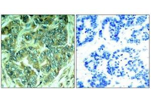 Immunohistochemical analysis of paraffin-embedded human breast carcinoma tissue using p62Dok(Phospho-Tyr398) Antibody(left) or the same antibody preincubated with blocking peptide(right). (DOK1 Antikörper  (pTyr398))