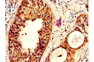 IHC image of ABIN7169337 diluted at 1:500 and staining in paraffin-embedded human cervical cancer performed on a Leica BondTM system. (SERPINB3 Antikörper  (AA 2-383))