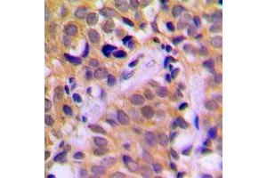 Immunohistochemical analysis of CHRNA1 staining in human prostate cancer formalin fixed paraffin embedded tissue section. (CHRNA1 Antikörper  (Center))