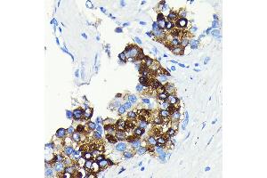 Immunohistochemistry of paraffin-embedded human liver cancer using C-Reactive Protein (C-Reactive Protein (CRP)) Rabbit mAb (ABIN7265972) at dilution of 1:100 (40x lens). (CRP Antikörper)