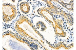 ABIN6260986 and ABIN6266876 at 1/100 staining Human ovarian cancer by IHC-P.