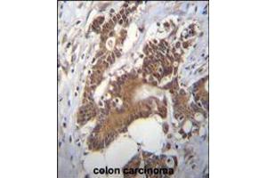 PCYT1A Antibody immunohistochemistry analysis in formalin fixed and paraffin embedded human colon carcinoma followed by peroxidase conjugation of the secondary antibody and DAB staining. (PCYT1A Antikörper  (N-Term))