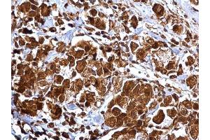 IHC-P Image MMP2 antibody detects MMP2 protein at cytosol and nucleus on human breast carcinoma by immunohistochemical analysis. (MMP2 Antikörper)