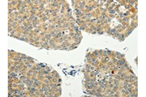 The image on the left is immunohistochemistry of paraffin-embedded Human liver cancer tissue using ABIN7128020(SPIN4 Antibody) at dilution 1/20, on the right is treated with fusion protein. (SPIN4 Antikörper)