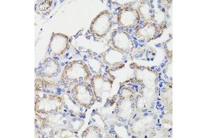 Immunohistochemistry of paraffin-embedded human breast cancer using PDCD10 antibody (ABIN7269540) at dilution of 1:100 (40x lens).