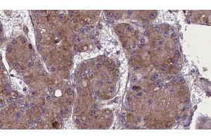 ABIN6272765 at 1/100 staining Human liver cancer tissue by IHC-P. (OR52R1 Antikörper)