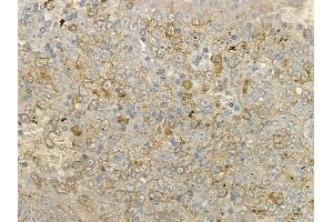 ABIN6266251 and ABIN6277406 at 1/100 staining human melanoma by IHC-P. (MMP25 Antikörper  (Internal Region))
