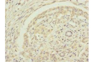 Immunohistochemistry of paraffin-embedded human pancreatic cancer using ABIN7151440 at dilution of 1:100 (EDIL3 Antikörper  (AA 60-300))