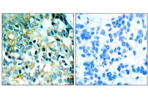 Immunohistochemical analysis of paraffin- embedded human breast carcinoma tissue using Src (phospho- Tyr418) antibody (E011091). (Src Antikörper  (pTyr418))