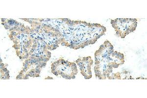 Immunohistochemistry of paraffin-embedded Human thyroid cancer tissue using FCGRT Polyclonal Antibody at dilution of 1:45(x200) (FcRn Antikörper)