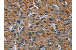 The image on the left is immunohistochemistry of paraffin-embedded Human liver cancer tissue using ABIN7130272(MSH5 Antibody) at dilution 1/30, on the right is treated with fusion protein. (MSH5 Antikörper)