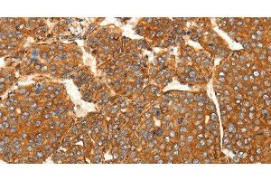 Immunohistochemistry of paraffin-embedded Human liver cancer tissue using SFRP1 Polyclonal Antibody at dilution 1:80 (SFRP1 Antikörper)