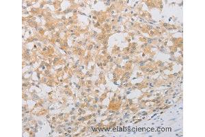 Immunohistochemistry of Human thyroid cancer using PDE4D Polyclonal Antibody at dilution of 1:20 (PDE4D Antikörper)