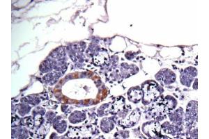 IHC-P Image Immunohistochemical analysis of human salivary gland cancer, using CAD, antibody at 1:100 dilution. (CAD Antikörper  (C-Term))
