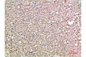 Immunohistochemical analysis of paraffin-embedded Human Liver Carcinoma Tissue using TTR Mouse mAb diluted at 1:200. (TTR Antikörper)