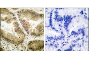 Immunohistochemistry analysis of paraffin-embedded human lung carcinoma tissue, using HDAC7 Antibody. (HDAC7 Antikörper  (AA 901-950))