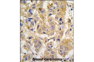 Formalin-fixed and paraffin-embedded human breast carcinoma tissue reacted with MIPEP antibody , which was peroxidase-conjugated to the secondary antibody, followed by DAB staining. (MIPEP Antikörper  (AA 307-336))