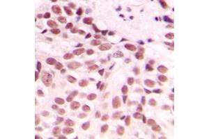 Immunohistochemical analysis of GADD153 staining in human breast cancer formalin fixed paraffin embedded tissue section. (DDIT3 Antikörper  (Center))