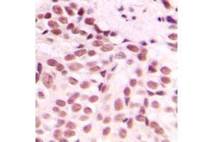 Immunohistochemical analysis of GADD153 staining in human breast cancer formalin fixed paraffin embedded tissue section.