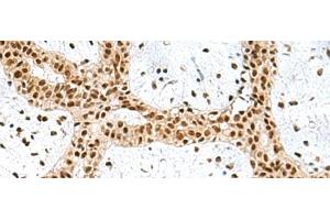 Immunohistochemistry of paraffin-embedded Human breast cancer tissue using PRPF40A Polyclonal Antibody at dilution of 1:60(x200) (PRPF40A Antikörper)