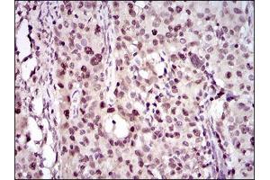 Immunohistochemical analysis of paraffin-embedded cervical cancer tissues using PCNA mouse mAb with DAB staining. (PCNA Antikörper  (AA 53-196))