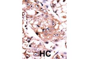 Formalin-fixed and paraffin-embedded human cancer tissue reacted with the primary antibody, which was peroxidase-conjugated to the secondary antibody, followed by AEC staining. (PPP2CA Antikörper  (C-Term))