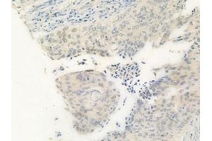 ABIN6259919 and ABIN6269342 at 1/100 staining human cervical carcinoma by IHC-P.