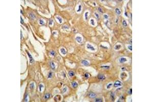 Immunohistochemistry analysis in human lung carcinoma tissue (Formalin-fixed, Paraffin-embedded) using RIPK3 / RIP3  Antibody , followed by peroxidase-conjugated secondary antibody and DAB staining. (RIPK3 Antikörper  (Middle Region))