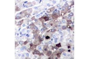 Immunohistochemical analysis of SGTA staining in human liver cancer formalin fixed paraffin embedded tissue section. (SGTA Antikörper)