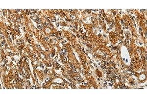 Immunohistochemistry of paraffin-embedded Human gastic cancer using RPLP0 Polyclonal Antibody at dilution of 1:40 (RPLP0 Antikörper)
