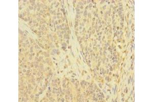Immunohistochemistry of paraffin-embedded human ovarian cancer using ABIN7173908 at dilution of 1:100 (TNFAIP6 Antikörper  (AA 18-277))