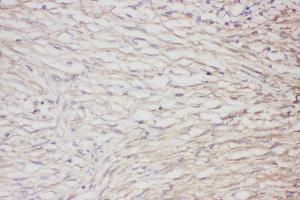 Anti-GFAP Picoband antibody,  IHC(P): Human meningioma Tissue (GFAP Antikörper  (AA 93-432))