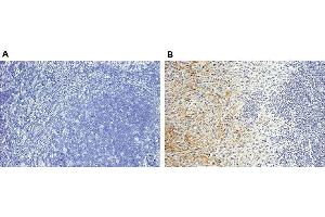 Staining of endogenous human Periostin in human breast cancer tissues (paraffin sections) by using Periostin, mAb (Stiny-1) . (Periostin Antikörper  (full length))