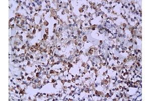 Formalin-fixed and paraffin embedded: human endometrium carcinoma labeled with Anti-Caspase-6 Polyclonal Antibody (ABIN725525), Unconjugated 1:200 followed by conjugation to the secondary antibody and DAB staining (Caspase 6 Antikörper  (AA 151-250))