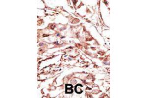 Formalin-fixed and paraffin-embedded human cancer tissue reacted with DKK4 polyclonal antibody  , which was peroxidase-conjugated to the secondary antibody, followed by DAB staining.