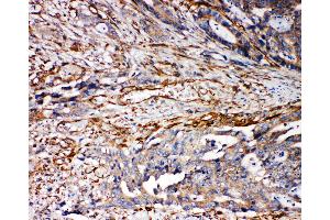 Anti-VRL1 antibody, IHC(P) IHC(P): Human Mammary Cancer Tissue (TRPV2 Antikörper  (N-Term))