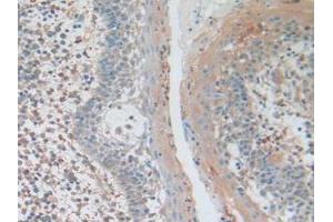 IHC-P analysis of Human Skin Cancer Tissue, with DAB staining. (AKT3 Antikörper  (AA 46-338))