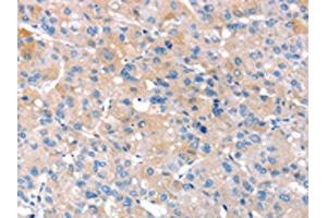 The image on the left is immunohistochemistry of paraffin-embedded Human liver cancer tissue using ABIN7130903(RNF214 Antibody) at dilution 1/20, on the right is treated with fusion protein. (RNF214 Antikörper)