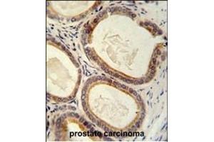 TR antibody (C-term) (ABIN652176 and ABIN2840578) immunohistochemistry analysis in formalin fixed and paraffin embedded human prostate carcinoma followed by peroxidase conjugation of the secondary antibody and DAB staining. (TRAM2 Antikörper  (C-Term))