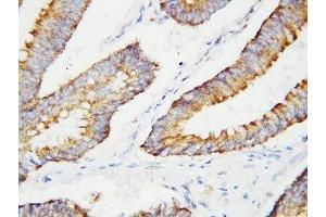 IHC-P: BCAT2 antibody testing of human colon cancer tissue (BCAT2 Antikörper  (C-Term))
