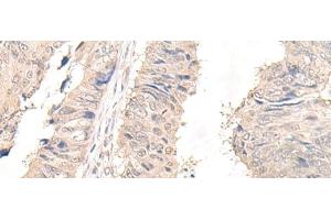 Immunohistochemistry of paraffin-embedded Human lung cancer tissue using OLA1 Polyclonal Antibody at dilution of 1:45(x200) (OLA1 Antikörper)