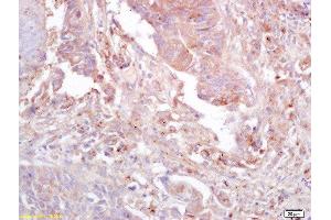 Formalin-fixed and paraffin embedded human lung carcinoma labeled with Anti-GnRHR Polyclonal Antibody, Unconjugated  at 1:200 followed by conjugation to the secondary antibody and DAB staining (FAK Antikörper  (pTyr397))
