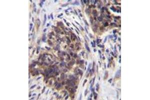 Immunohistochemistry analysis in formalin fixed and paraffin embedded human lung carcinoma reacted with Alpha-glucosidase Antibody (N-term) followed by peroxidase conjugation of the secondary antibody and DAB staining.
