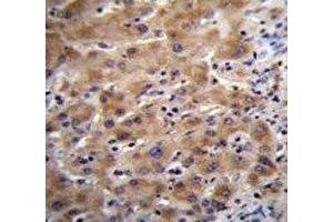 Glypican 3 antibody immunohistochemistry analysis in formalin fixed and paraffin embedded human liver tissue. (Glypican 3 Antikörper  (AA 21-50))
