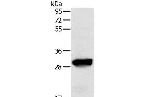 Western Blot analysis of Human liver cancer tissue using GSTO1 Polyclonal Antibody at dilution of 1:200 (GSTO1 Antikörper)