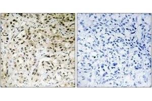 Immunohistochemistry analysis of paraffin-embedded human liver carcinoma tissue, using TAF5 Antibody.